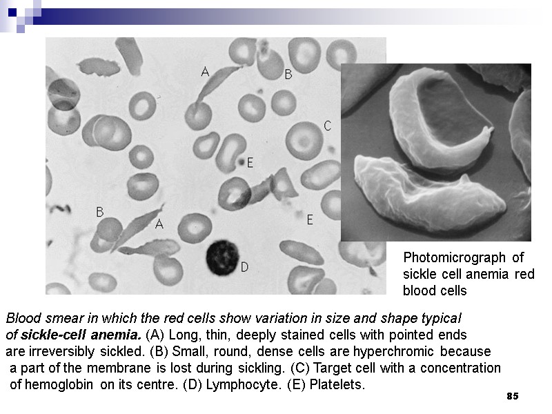 85 Photomicrograph of sickle cell anemia red blood cells Blood smear in which the
